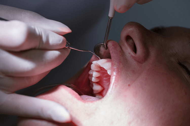 Chipped Tooth Chipped Tooth