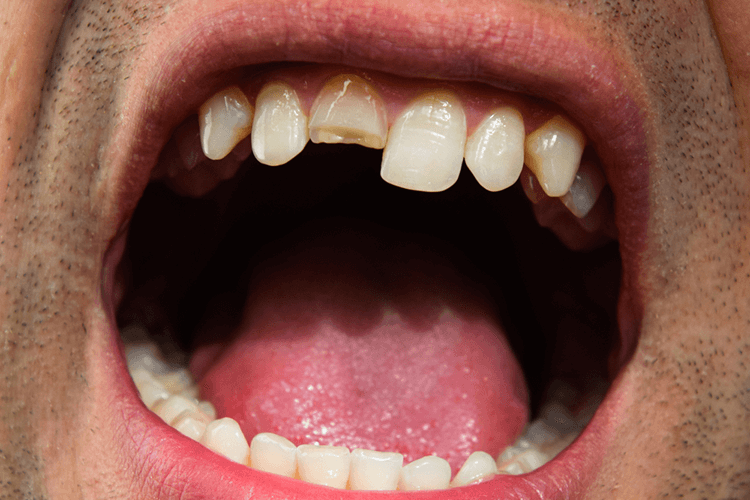 Cracked Tooth Cracked Tooth