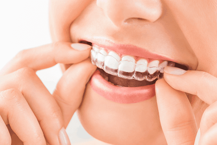 Gaps Between Teeth Gaps Between Teeth