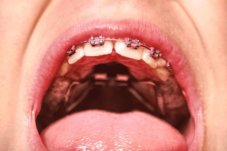 Gaps Between Teeth Gaps Between Teeth