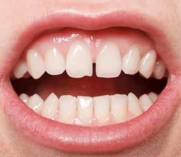 Gaps Between Teeth Gaps Between Teeth