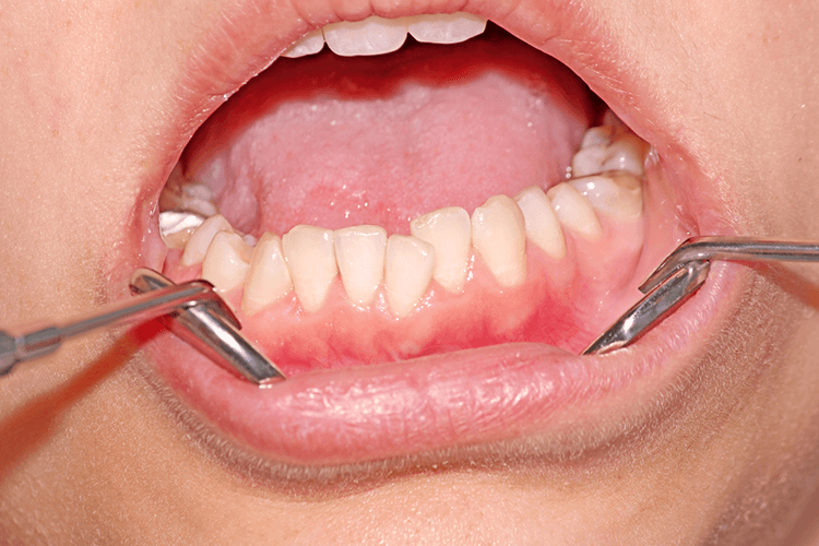 Gums Problem Gums Problem