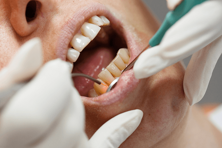 Gums Problem Gums Problem