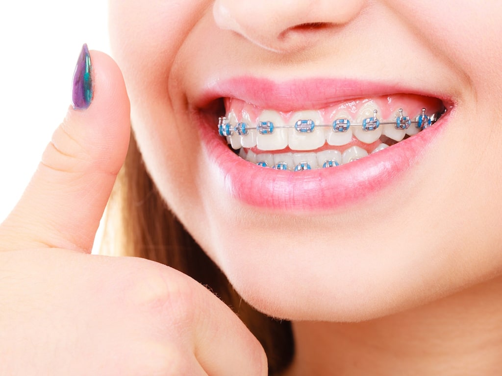 Gaps Between Teeth Gaps Between Teeth