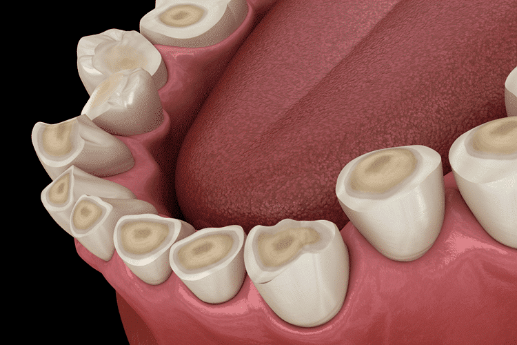Teeth Grinding Teeth Grinding